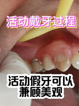 洁牙视频,专业洁牙步骤与技巧全解析