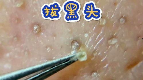 挤黑头 视频,告别毛孔烦恼