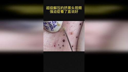 挤黑头 视频,告别毛孔烦恼