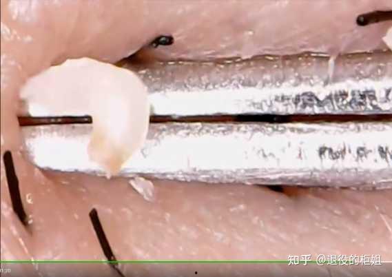 挤黑头 视频,告别毛孔烦恼