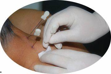 小针刀疗法视频,高效缓解疼痛的神奇疗法揭秘