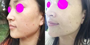 去痣视频,焕发肌肤光彩——跟随去痣视频教程