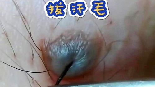 去痣视频,焕发肌肤光彩——跟随去痣视频教程