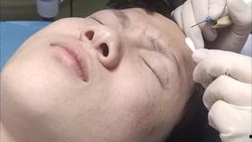 去痣视频,焕发肌肤光彩——跟随去痣视频教程