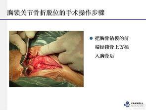 接骨视频,居家必备急救技巧