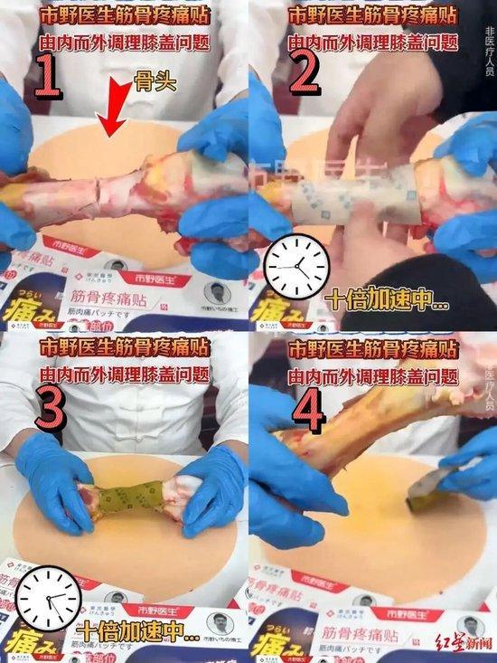 接骨视频,居家必备急救技巧